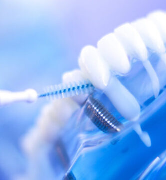 Consejos preparar una cirugía de implantes dentales con éxito